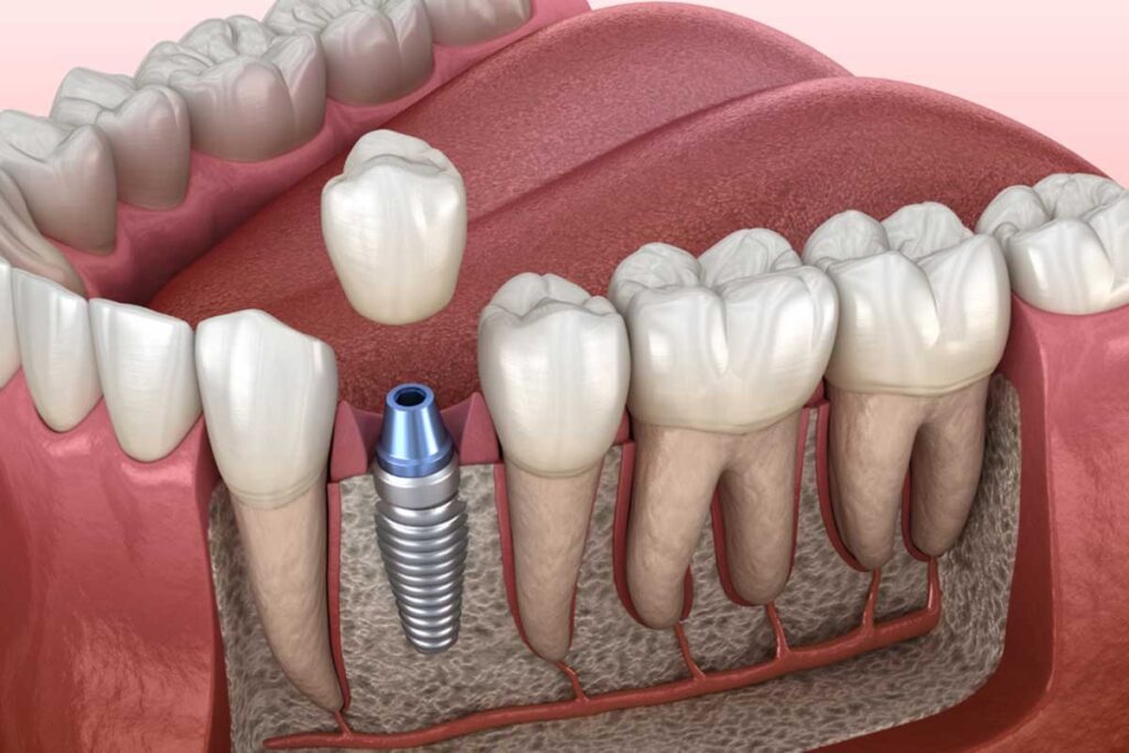 Implants at Agoura Advanced Dentistry